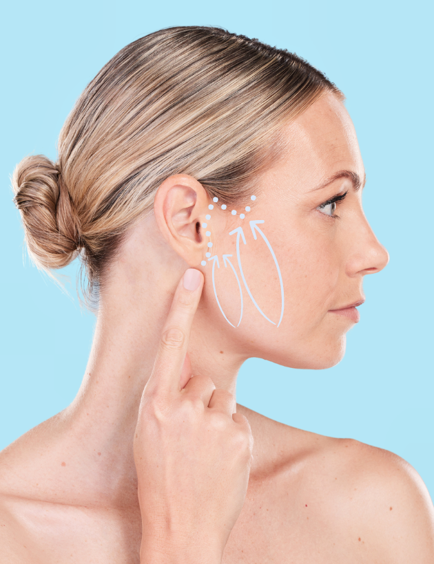 Fadenlifting Technik mit hauchdünnen Fäden