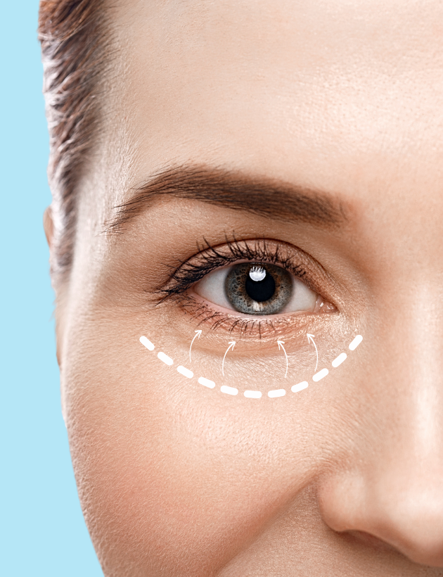 Fadenlifting Technik mit hauchdünnen Fäden